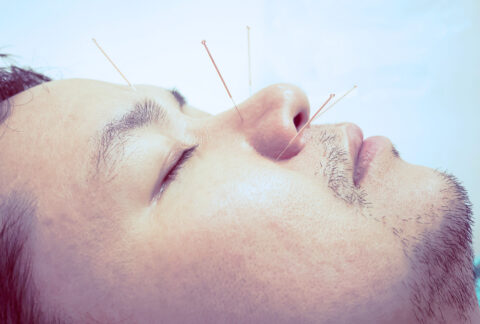 Acupuncture faciale